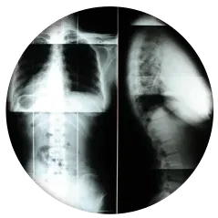 Black-and-white radiographic images showing frontal and side views of the spine and upper torso.